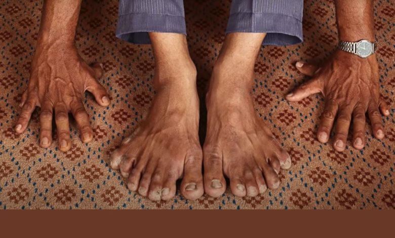 Devendra Suthar získal svetový rekord za najväčší počet prstov (reprofoto youtube.com/ Guinness World Records)